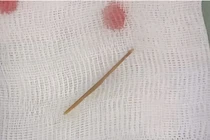 Bé 6 tuổi thủng ruột vì... nuốt tăm tre dài 4cm