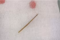 Bé 6 tuổi thủng ruột vì... nuốt tăm tre dài 4cm