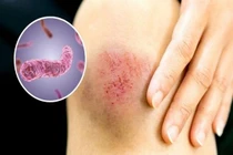 Bé gái 14 tuổi nhiễm “vi khuẩn ăn thịt người”, phòng bệnh thế nào?