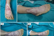 Kỹ thuật ghép da: Chi phí phẫu thuật, thực hiện ở đâu an toàn, hiệu quả?