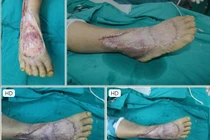 Kỹ thuật ghép da: Chi phí phẫu thuật, thực hiện ở đâu an toàn, hiệu quả?