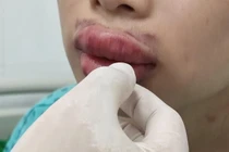 Môi sưng phồng, nhiễm khuẩn sau tiêm filler 'Hàn Quốc' giá rẻ