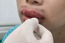 Môi sưng phồng, nhiễm khuẩn sau tiêm filler 'Hàn Quốc' giá rẻ