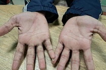 Bị... ghẻ dù rất sạch sẽ