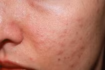 Lý do mụn trứng cá dễ tái phát, khó trị dứt điểm