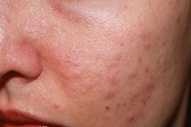 Lý do mụn trứng cá dễ tái phát, khó trị dứt điểm