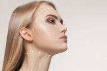 Cách cấy chỉ làm đẹp an toàn, không gây biến chứng