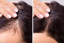 8 cách tự nhiên giúp kích thích tóc mọc nhanh