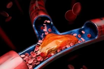 Bí kíp phòng ngừa cục máu đông, ngừa đột quỵ