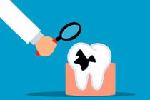 Bật mí "thói quen nhỏ, lợi ích to" giúp ngừa sâu răng hiệu quả