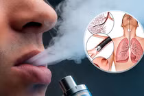 Thử "làm người lớn", nhiều học sinh nguy kịch vì thuốc lá điện tử