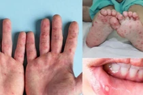 Bài thuốc đông y trị tay chân miệng