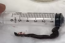 Phát hiện con vắt dài hơn 6 cm sống cả tuần trong mũi bệnh nhân