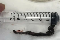 Phát hiện con vắt dài hơn 6 cm sống cả tuần trong mũi bệnh nhân