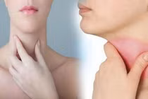 Nếu thấy 3 tín hiệu này ở cổ, cần đi khám K tuyến giáp ngay
