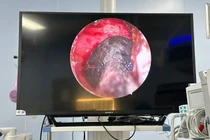 Đau vùng đỉnh đầu bên phải, đi khám phát hiện nấm xoang bướm