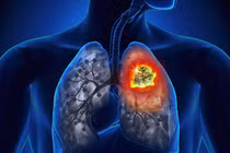 Loại nước nuôi tế bào ung thư