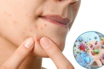 Điều gì xảy ra khi nặn mụn sai cách?