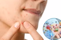 Điều gì xảy ra khi nặn mụn sai cách?