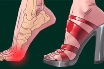 Đi giày cao gót quá nhiều, nguy hiểm đến 4 bộ phận trên cơ thể