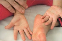 Bệnh tay chân miệng: Dấu hiệu cần đi bệnh viện, cách chăm sóc trẻ tại nhà