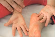 Bệnh tay chân miệng: Dấu hiệu cần đi bệnh viện, cách chăm sóc trẻ tại nhà