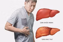 Dấu hiệu ung thư gan giai đoạn đầu dễ nhầm với bệnh lý khác