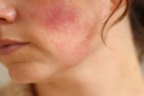 Nhận biết da bị kích ứng do mỹ phẩm