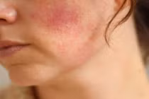 Nhận biết da bị kích ứng do mỹ phẩm