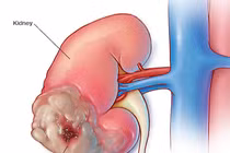 6 triệu chứng ung thư thận nhiều người bỏ qua