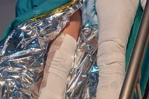 Hai bệnh nhân bỏng nặng do nổ điện thoại để sạc qua đêm