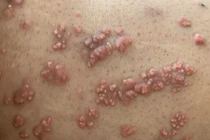 U nổi khắp người do rối loạn mỡ máu: Dễ tai biến mạch máu não