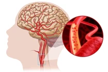 Bí kíp chữa thiểu năng tuần hoàn não