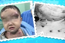 Bé 1 tuổi bị mụn đắp lá phải phẫu thuật nhiều khối ổ mủ trên mặt