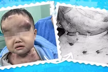 Bé 1 tuổi bị mụn đắp lá phải phẫu thuật nhiều khối ổ mủ trên mặt