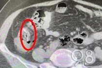 Cố nuốt xương cá khi hóc, người phụ nữ bị thủng ruột 