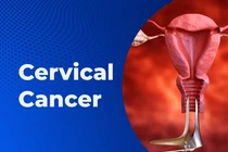Ai dễ mắc ung thư cổ tử cung?