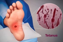 Vi khuẩn uốn ván sản sinh độc tố nguy hiểm như thế nào?