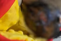 Bé sơ sinh bỏng nặng da đầu do y tá tắm sai cách