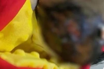 Bé sơ sinh bỏng nặng da đầu do y tá tắm sai cách