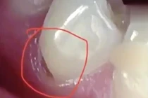 Đánh răng theo chiều ngang hơn 20 năm, cô gái bị vỡ chân răng