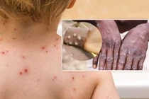 6 điều cần biết về bệnh đậu mùa khỉ
