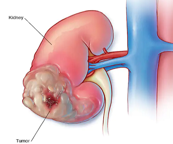 Ảnh minh họa: Mayoclinic.org.