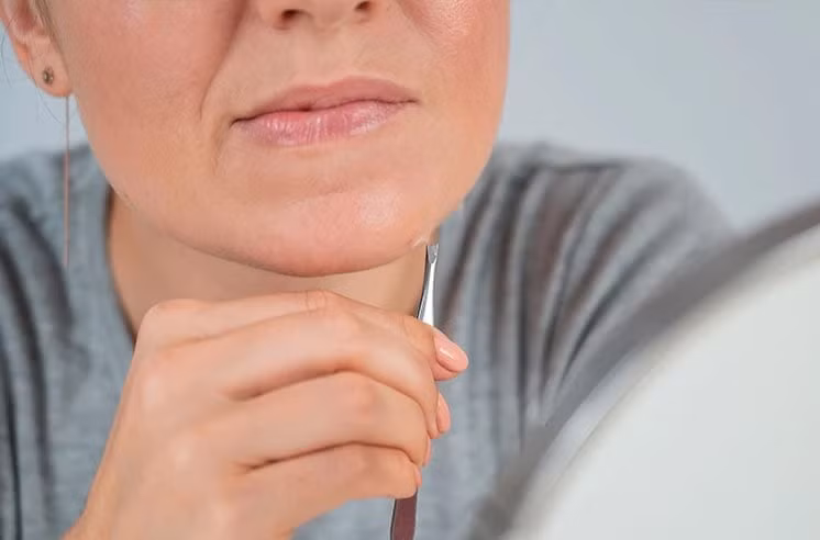 Rậm lông và rụng tóc: Theo Cleveland Clinic, PCOS có thể gây ra tình trạng mọc lông quá mức trên mặt và cơ thể, hay còn gọi là rậm lông, cũng như khiến tóc mỏng đi trên da đầu. Các triệu chứng này là hệ quả của nồng độ hormone nam (androgen) cao trong cơ thể. Lông phát triển quá mức có thể xuất hiện ở các khu vực như khuôn mặt, cổ, ngực, bụng, lưng dưới và đùi. Ảnh: Fertilityfamily.