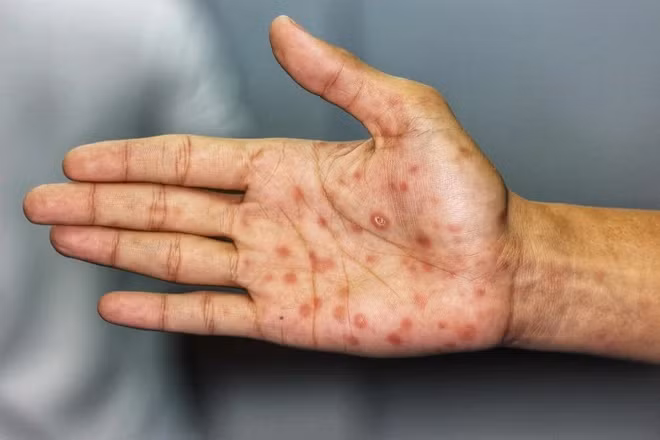 6 benh lay truyen qua duong tinh duc pho bien nhat