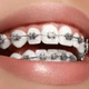 Soi giá dịch vụ Nha khoa Thẩm mỹ Anh Dental 