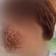 Nhiễm virus Herpes trên da có thể dẫn đến biến chứng nặng nếu không điều trị kịp thời