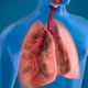 Bệnh phổi tắc nghẽn mạn tính, nguy cơ gia tăng trong mùa đông lạnh