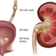 Triệu chứng cảnh báo sỏi niệu quản, không nên bỏ qua