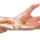 Nhận biết dấu hiệu hội chứng ống cổ tay để phòng tránh tổn thương